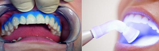 Tẩy trắng răng bằng laser có thực sự an toàn, hiệu quả?