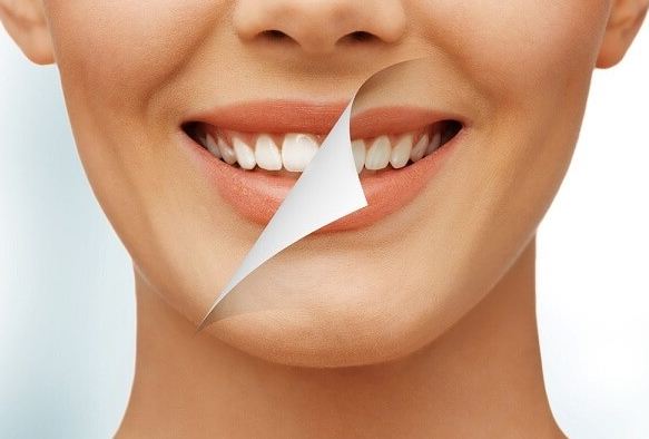 Tẩy trắng răng là phương pháp được nhiều người lựa chọn