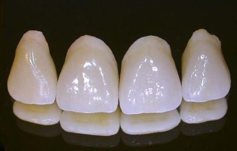 ăng sứ có lớp sườn kim loại( răng sứ titan và kim loại)