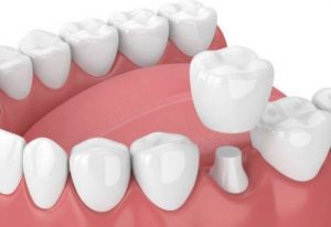 Bọc răng sứ cho hàm răng đẹp, chức năng ăn nhai tốt