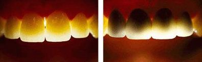 Hình ảnh 2 loại răng sứ trước ánh sáng đèn