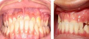 Ảnh hưởng của răng mọc lệch