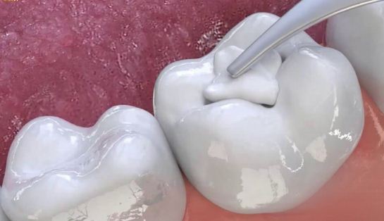 Trám răng để bảo vệ răng vĩnh viễn