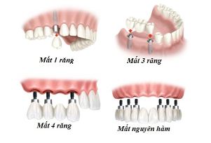 Trồng răng Implant được nhiều người lựa chọn