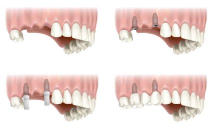 Kỹ thuật trồng răng Implant
