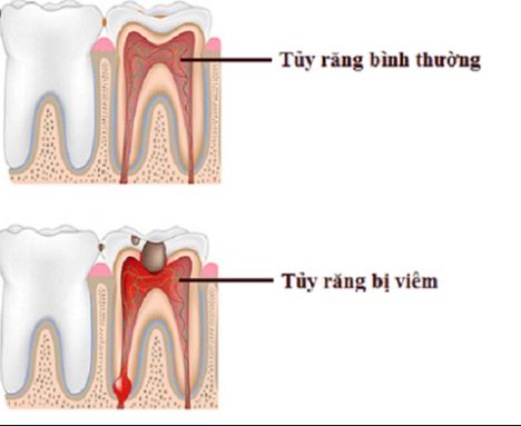 Răng bị viêm tủy và răng bình thường