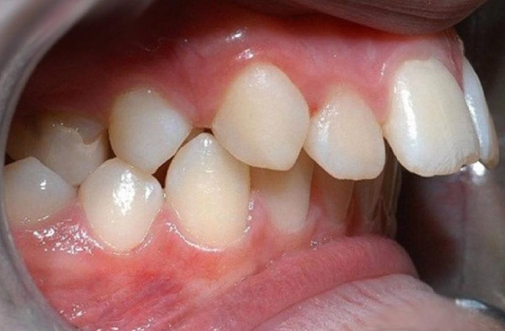 Lý do nên niềng răng hay chỉnh nha sớm