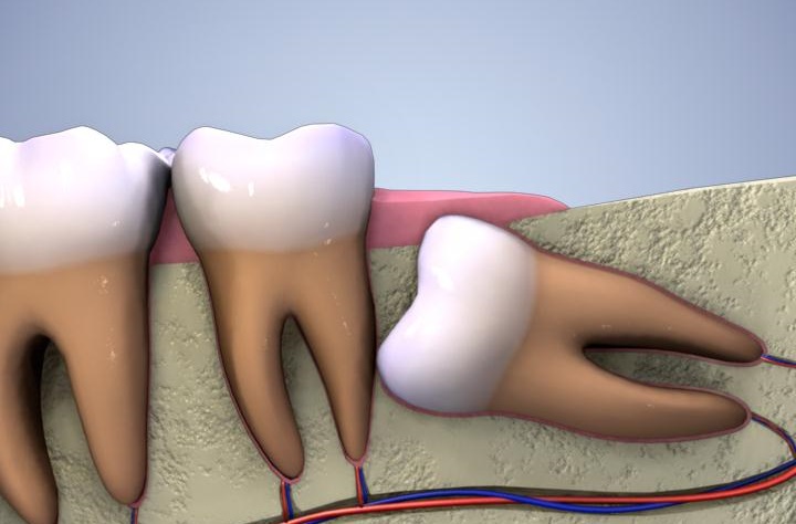 Nhổ răng số 8 có đau không? Nhổ răng số 8 hàm dưới có nguy hiểm không