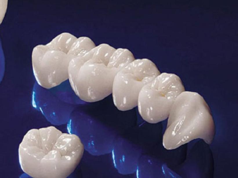 tìm hiểu về răng sứ kim loại