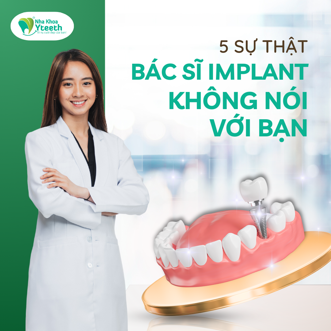 5 sự thật bác sĩ trồng răng implant không nói với bạn