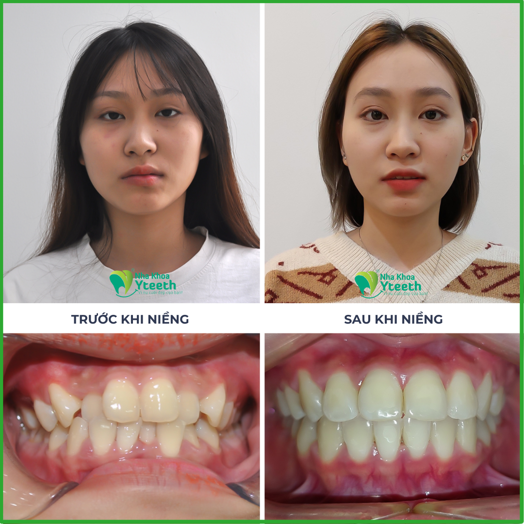 Sự thay đổi của khuôn mặt sau khi niềng răng
