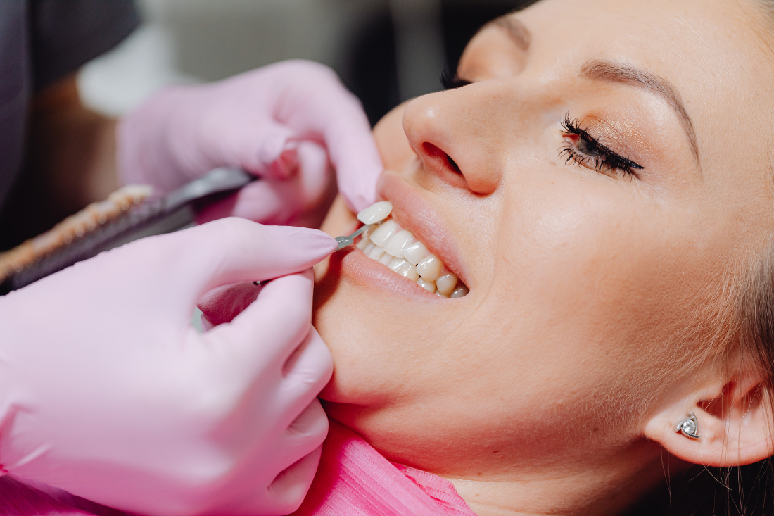 Dán sứ Veneer giúp tăng độ thẩm mỹ mà không cần mài răng