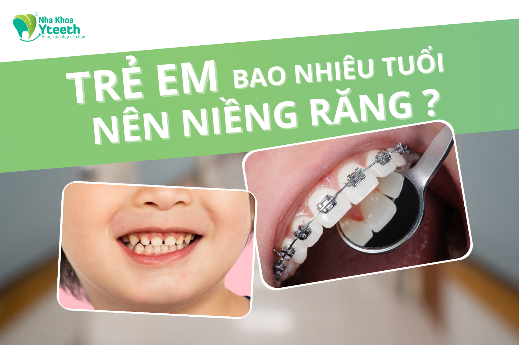 trẻ em bao nhiêu tuổi nên niềng răng ?