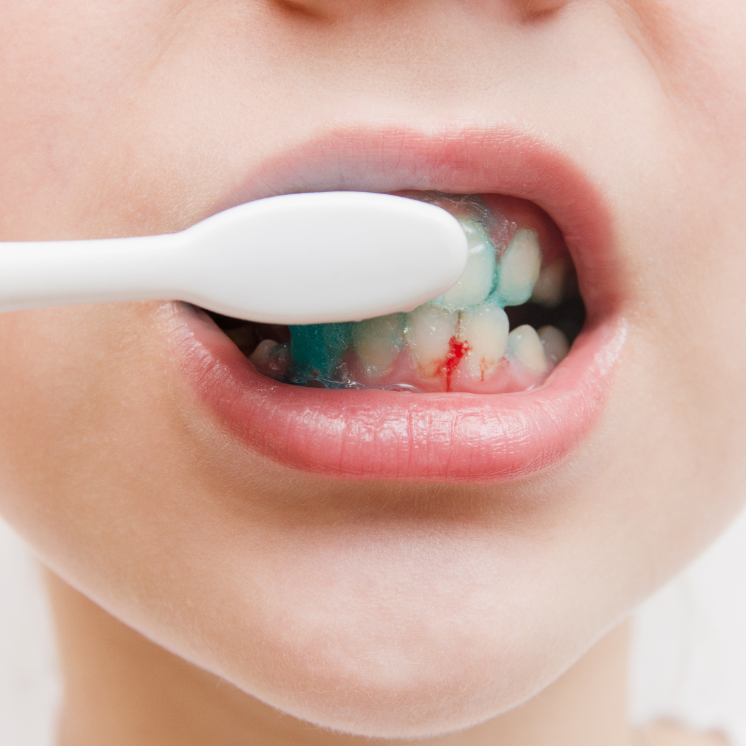 Chảy máu chân răng khi đảnh răng là dấu hiệu viêm nướu phổ biến